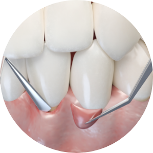 Mir Implant System image3